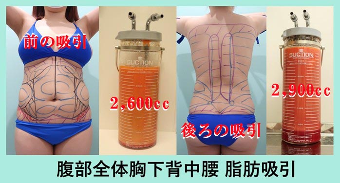 『腹、腰、背中』の超大量脂肪吸引 デザインと吸引脂肪