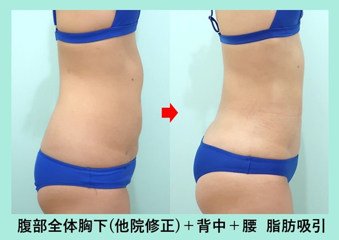 他院手術後のデコボコを綺麗に修正しつつ、ウエスト-7.5cm のサイズダウン 術前術後比較写真