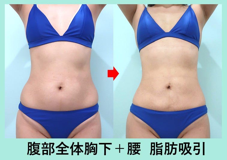 40代のガッツリ大量脂肪吸引でも「タルミ最小限」に! 美しいクビレを作る 術前と術後の比較写真