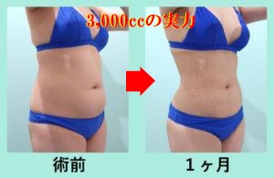 ウエスト -13cm! 純脂肪3,000cc吸引の凄い実力 術前と術後の比較写真
