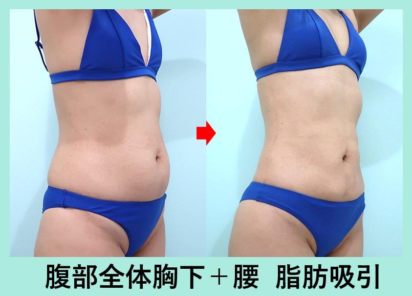 40代のガッツリ大量脂肪吸引でも「タルミ最小限」に! 美しいクビレを作る 術前と術後の比較写真