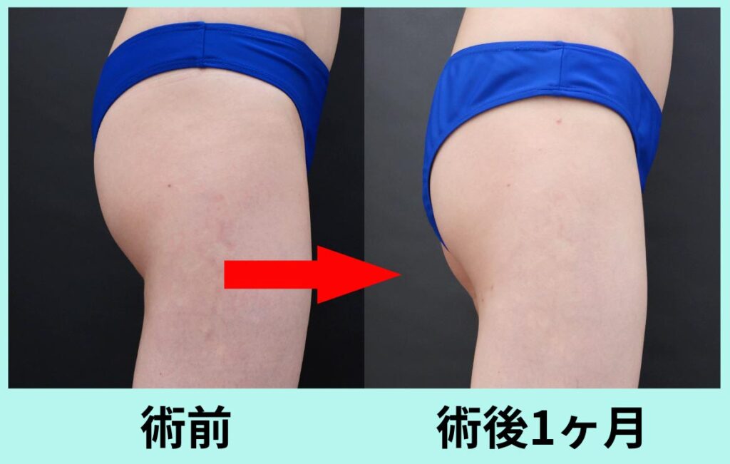 バナナロール修正手術
