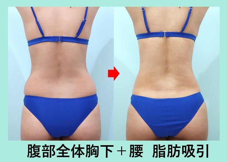 40代のガッツリ大量脂肪吸引でも「タルミ最小限」に! 美しいクビレを作る 術前と術後の比較写真