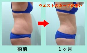 ウエスト -13cm! 純脂肪3,000cc吸引の凄い実力 術前と術後の比較写真