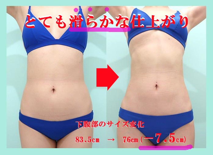 「鬼クビレ」作成術の劇的ビッフォーアフター 術前術後比較写真
