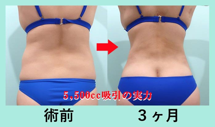 『腹、腰、背中』の超大量脂肪吸引の術前・術後比較写真
