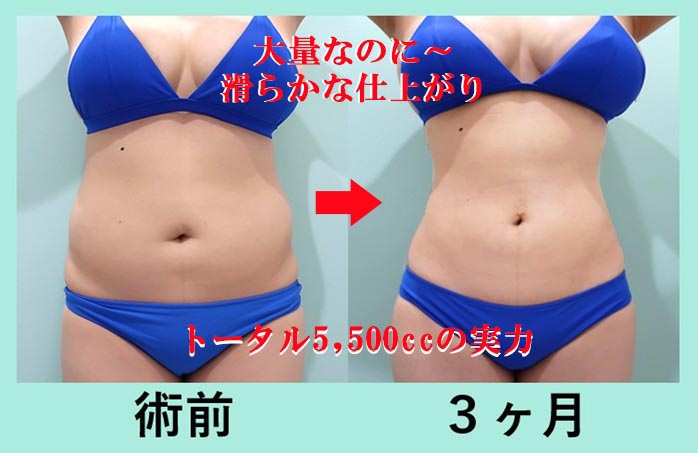 『腹、腰、背中』の超大量脂肪吸引