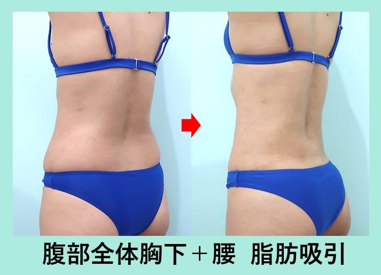 40代のガッツリ大量脂肪吸引でも「タルミ最小限」に! 美しいクビレを作る 術前と術後の比較写真