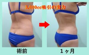 ウエスト -13cm! 純脂肪3,000cc吸引の凄い実力 術前と術後の比較写真