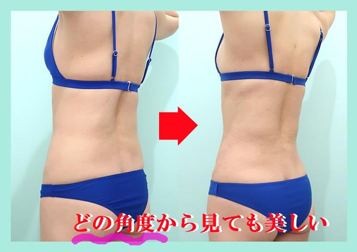 「鬼クビレ」作成術の劇的ビッフォーアフター 術前術後比較写真