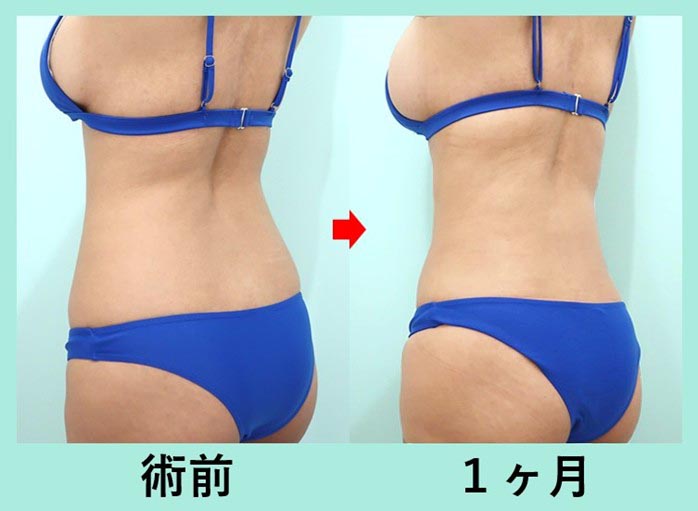 3,000cc脂肪吸引+脂肪豊胸で超メリハリボディへ!大量吸引脂肪の再配置! 術前術後比較写真