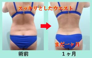 ウエスト -13cm! 純脂肪3,000cc吸引の凄い実力 術前と術後の比較写真