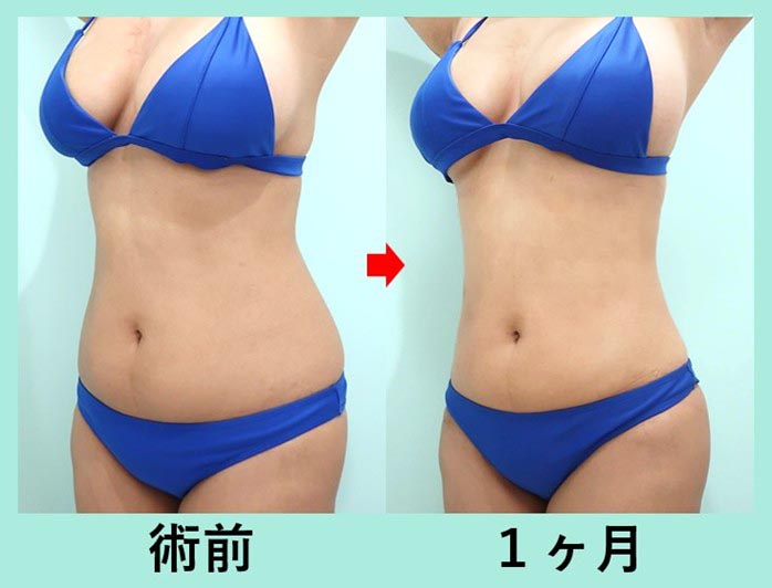 3,000cc脂肪吸引+脂肪豊胸で超メリハリボディへ!大量吸引脂肪の再配置! 術前術後比較写真