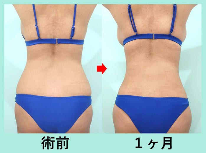 3,000cc脂肪吸引+脂肪豊胸で超メリハリボディへ!大量吸引脂肪の再配置! 術前術後比較写真