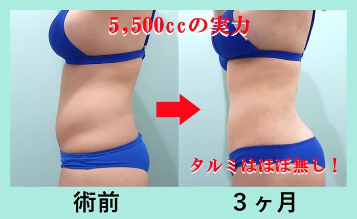 『腹、腰、背中』の超大量脂肪吸引の術前・術後比較写真