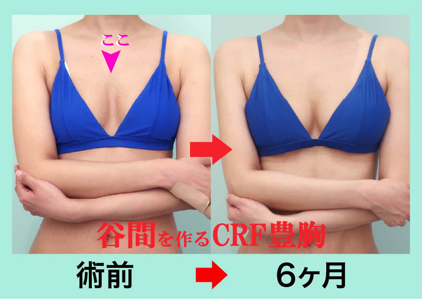 アブクラックス形成という腹部の特別な脂肪吸引法 とった脂肪で豊胸もしています。