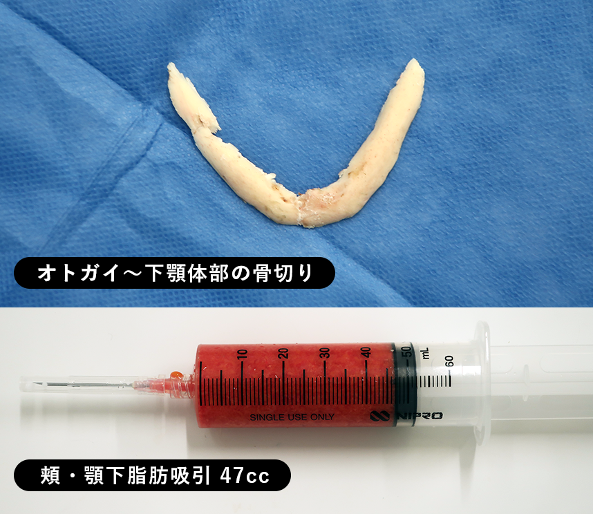 20268_ミニV+頬顎下脂肪吸引