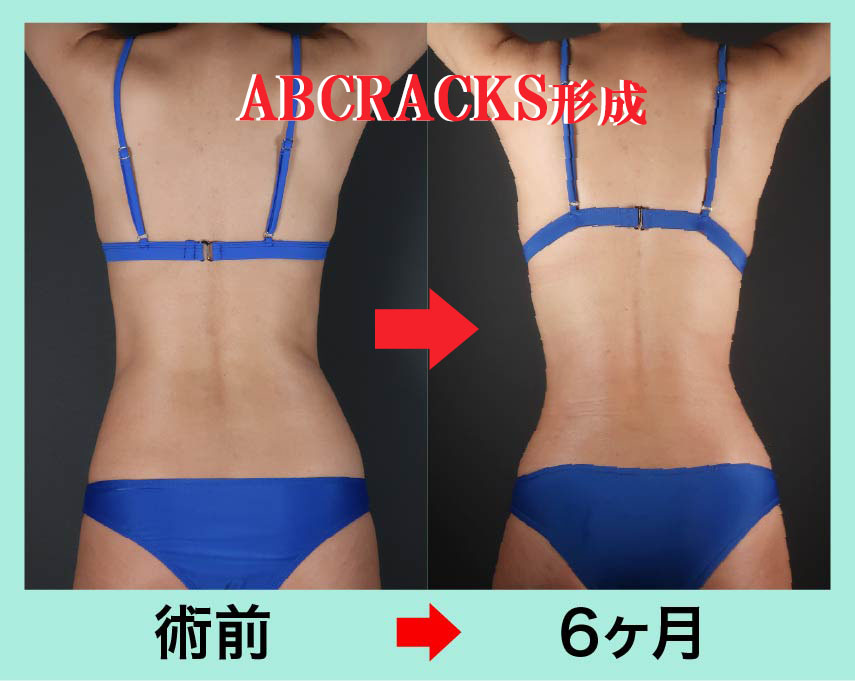アブクラックス形成という腹部の特別な脂肪吸引法 術前術後比較写真