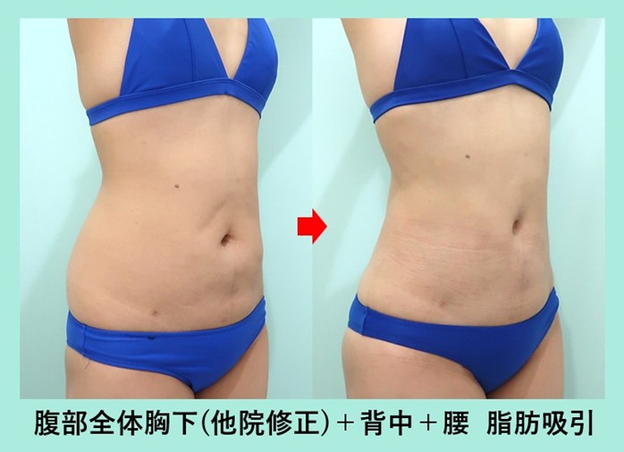 他院手術後のデコボコを綺麗に修正しつつ、ウエスト-7.5cm のサイズダウン 術前術後比較写真