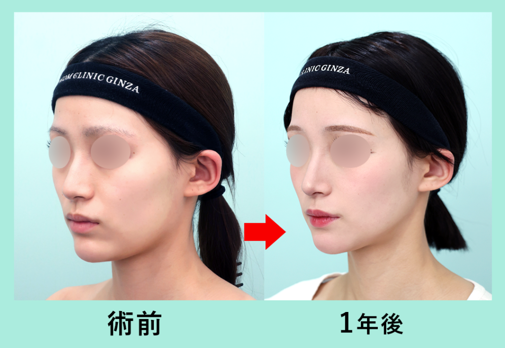 18300 骨切り_Vライン形成