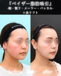 『『自分至上最高の輪郭で結婚式を』脂肪吸引でダイエットの限界を超える。』の画像