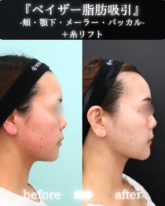 『『自分至上最高の輪郭で結婚式を』脂肪吸引でダイエットの限界を超える。』の画像