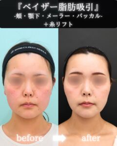 『『自分至上最高の輪郭で結婚式を』脂肪吸引でダイエットの限界を超える。』の画像