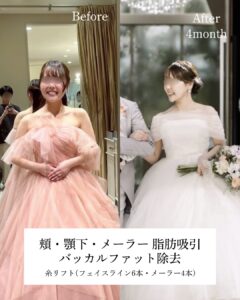 『『自分至上最高の輪郭で結婚式を』脂肪吸引でダイエットの限界を超える。』の画像