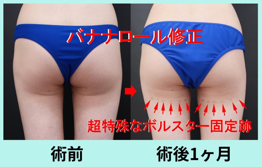 バナナロール修正手術