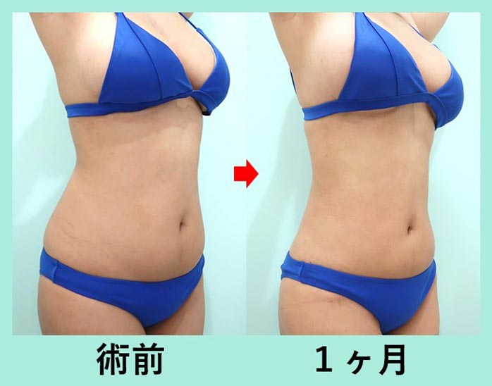 3,000cc脂肪吸引+脂肪豊胸で超メリハリボディへ!大量吸引脂肪の再配置! 術前術後比較写真