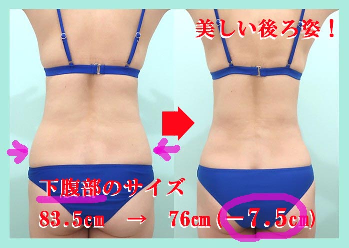 「鬼クビレ」作成術の劇的ビッフォーアフター 術前術後比較写真