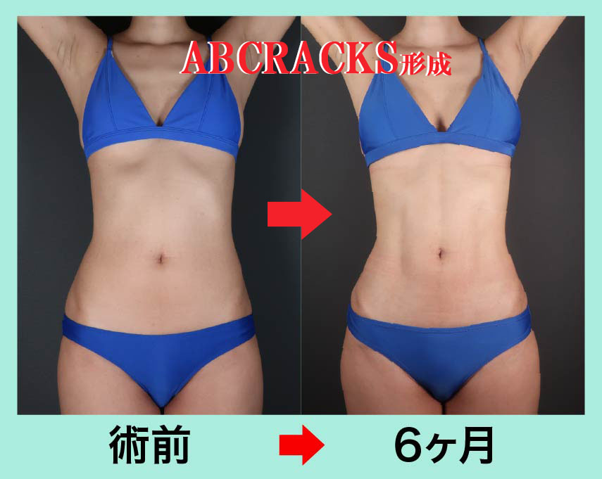 アブクラックス形成という腹部の特別な脂肪吸引法 術前術後比較写真