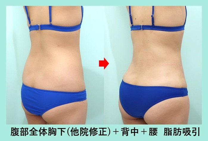 他院手術後のデコボコを綺麗に修正しつつ、ウエスト-7.5cm のサイズダウン 術前術後比較写真