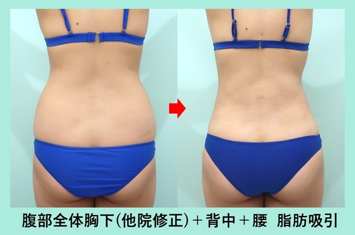 他院手術後のデコボコを綺麗に修正しつつ、ウエスト-7.5cm のサイズダウン 術前術後比較写真