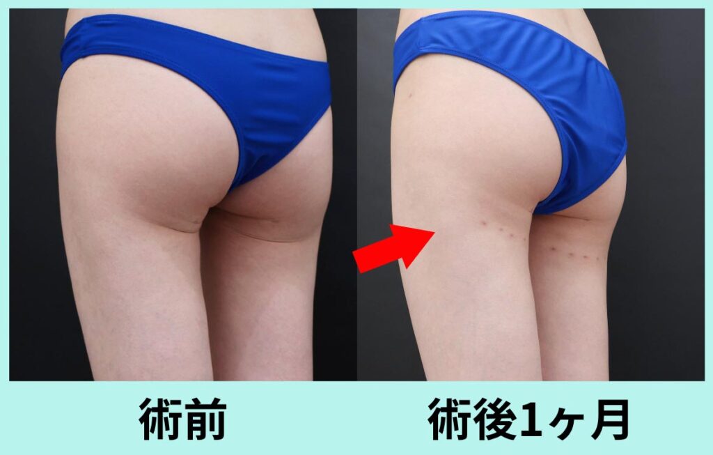 バナナロール修正手術
