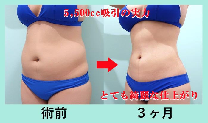 『腹、腰、背中』の超大量脂肪吸引の術前・術後比較写真