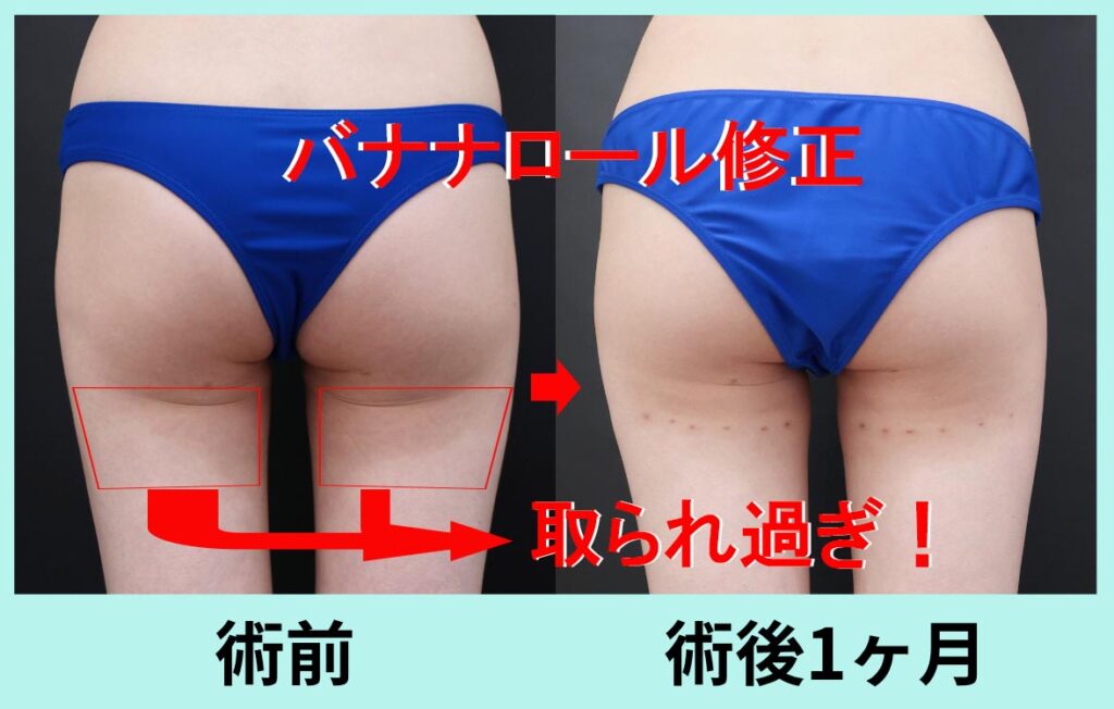 バナナロール修正手術 取られ過ぎ!