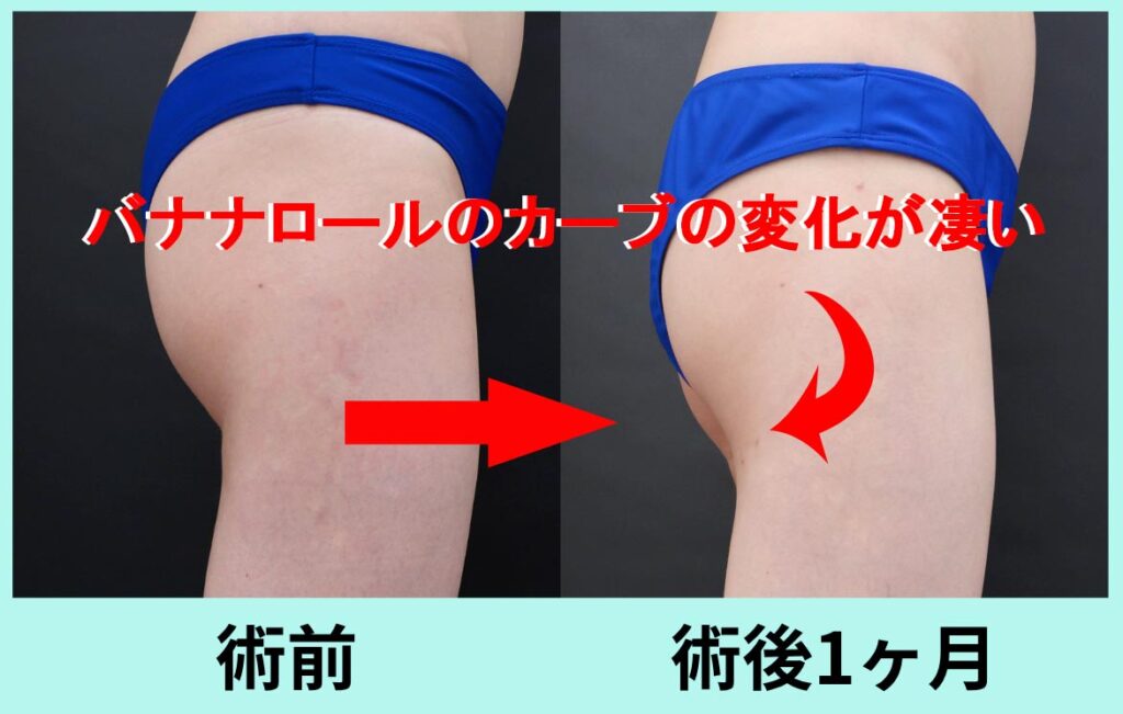 バナナロール修正