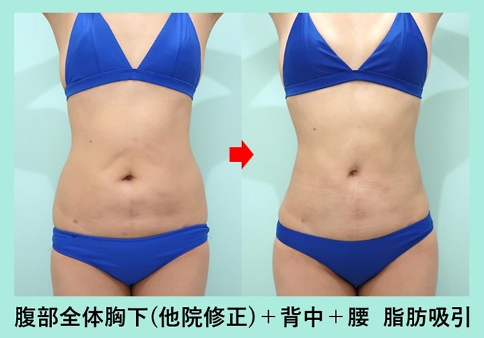 他院手術後のデコボコを綺麗に修正しつつ、ウエスト-7.5cm のサイズダウン 術前術後比較写真