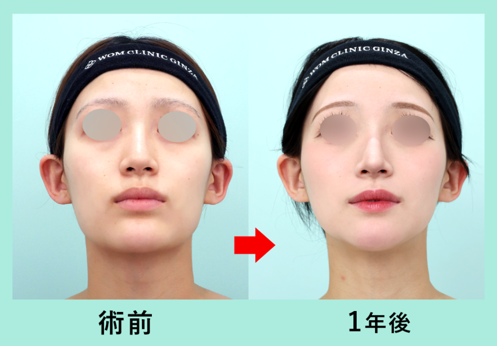 18300 骨切り_Vライン形成