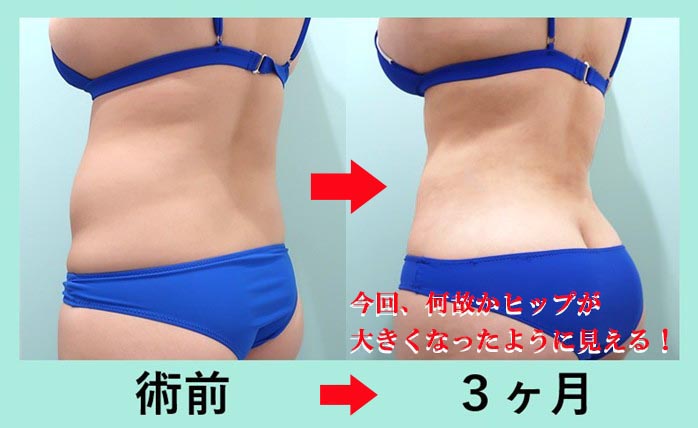 『腹、腰、背中』の超大量脂肪吸引の術前・術後比較写真