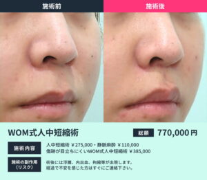 人中短縮術の術前と術後の比較写真01