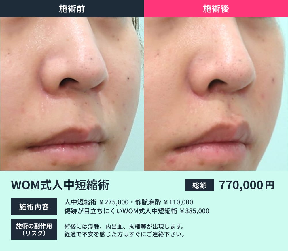 人中短縮術の術前と術後の比較写真01