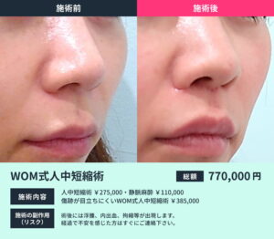 人中短縮術の術前と術後の比較写真02