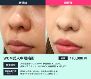 人中短縮術の術前と術後の比較写真03