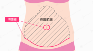 タミータック手術の剥離範囲