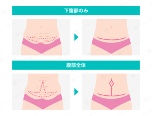 タミータック手術の施術箇所と切開範囲