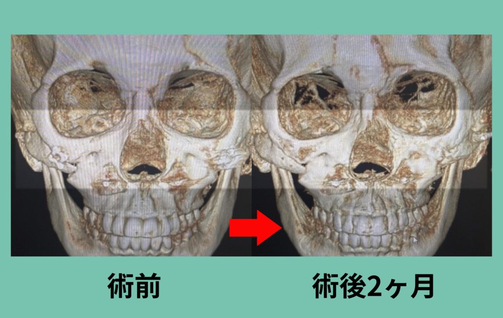 下部アイホールボーン削り