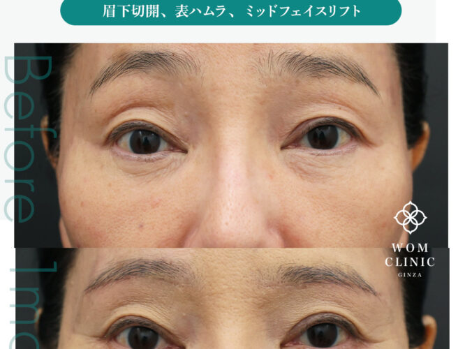 眉下切開、表ハムラ、ミッドフェイスリフト、クマ取り