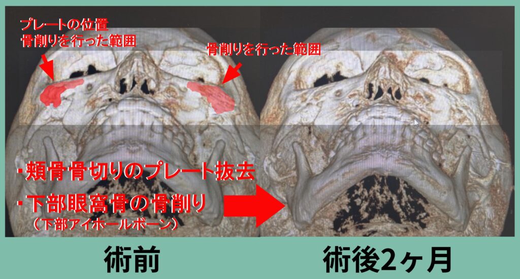 下部アイホールボーン削り